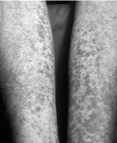  Пурпура на коже нижних конечностей у больного хроническим гепатитом С