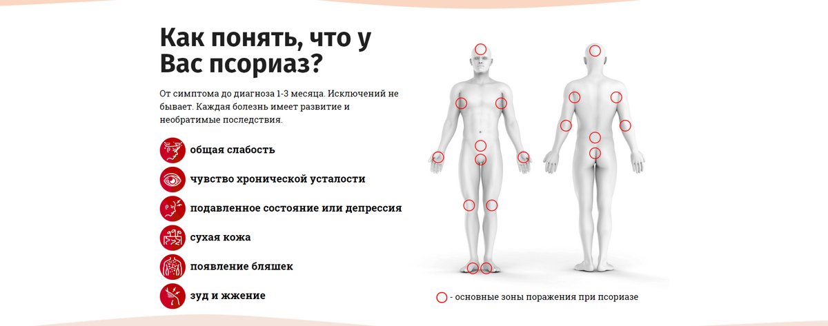 Симптомы псориаза