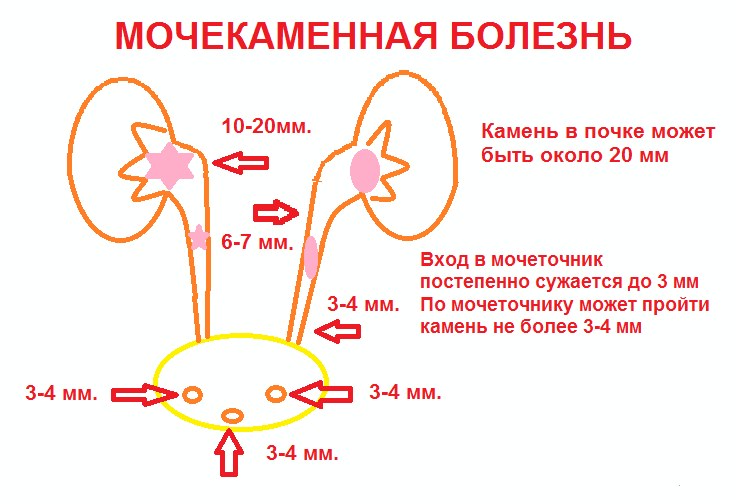 Мочекаменная болезнь Мочекаменная болезнь
