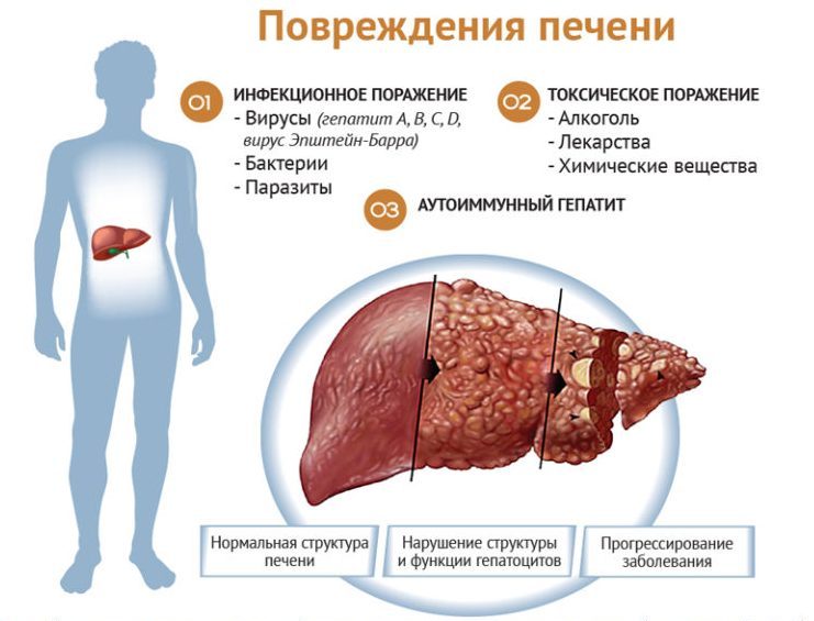 пигментные гепатозы