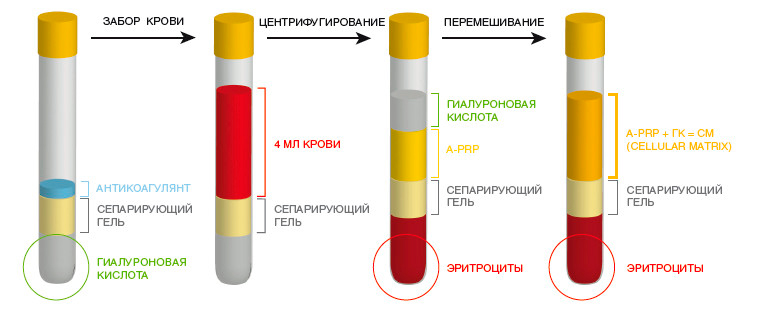 obogashchennaia trombotcitami plazma