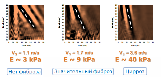 Результаты фиброскана